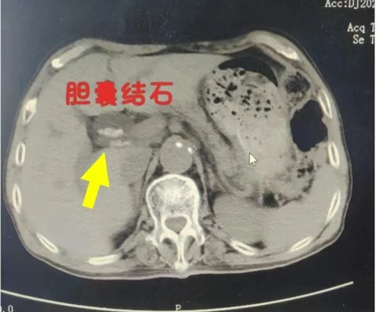 ​新野县人民医院普外科应用钬激光碎石术治疗复杂胆管结石 当前速递