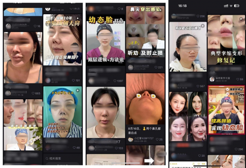 网红鼻风光不再 专家20年修复上万例问题鼻